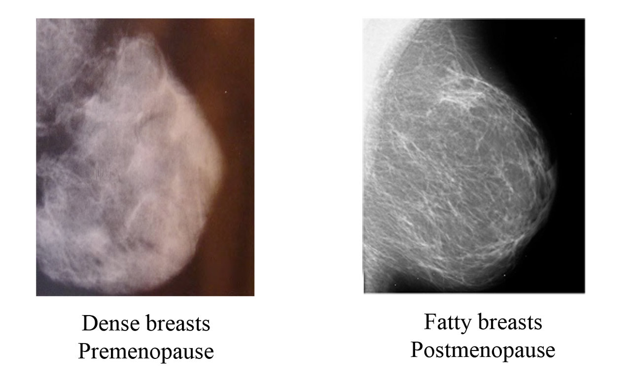 Dense Breast vs Fatty Breasts