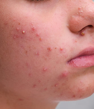 Acne and scar concerns
