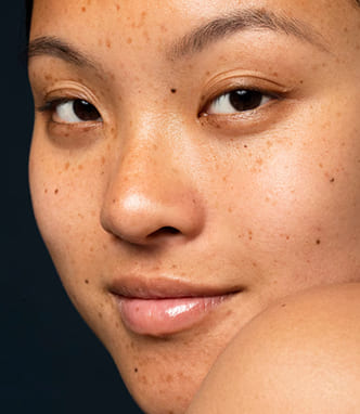 Pigmentation concerns