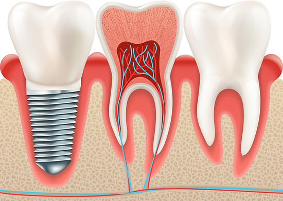 Dental implant set