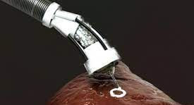 Bio-impression 3D pour la réparation de tissus endommagés à l'intérieur du corps.