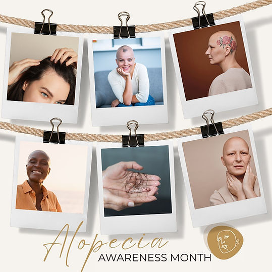Celebrating Alopecia Awareness Month ✨ This month, were shining a light on alopecia and em