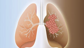Understanding Pulmonary Fibrosis and Qualifying for SSDI Benefits