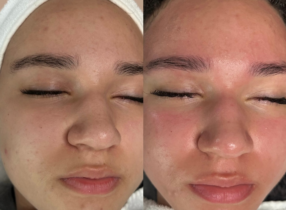 exfoliating clear skin