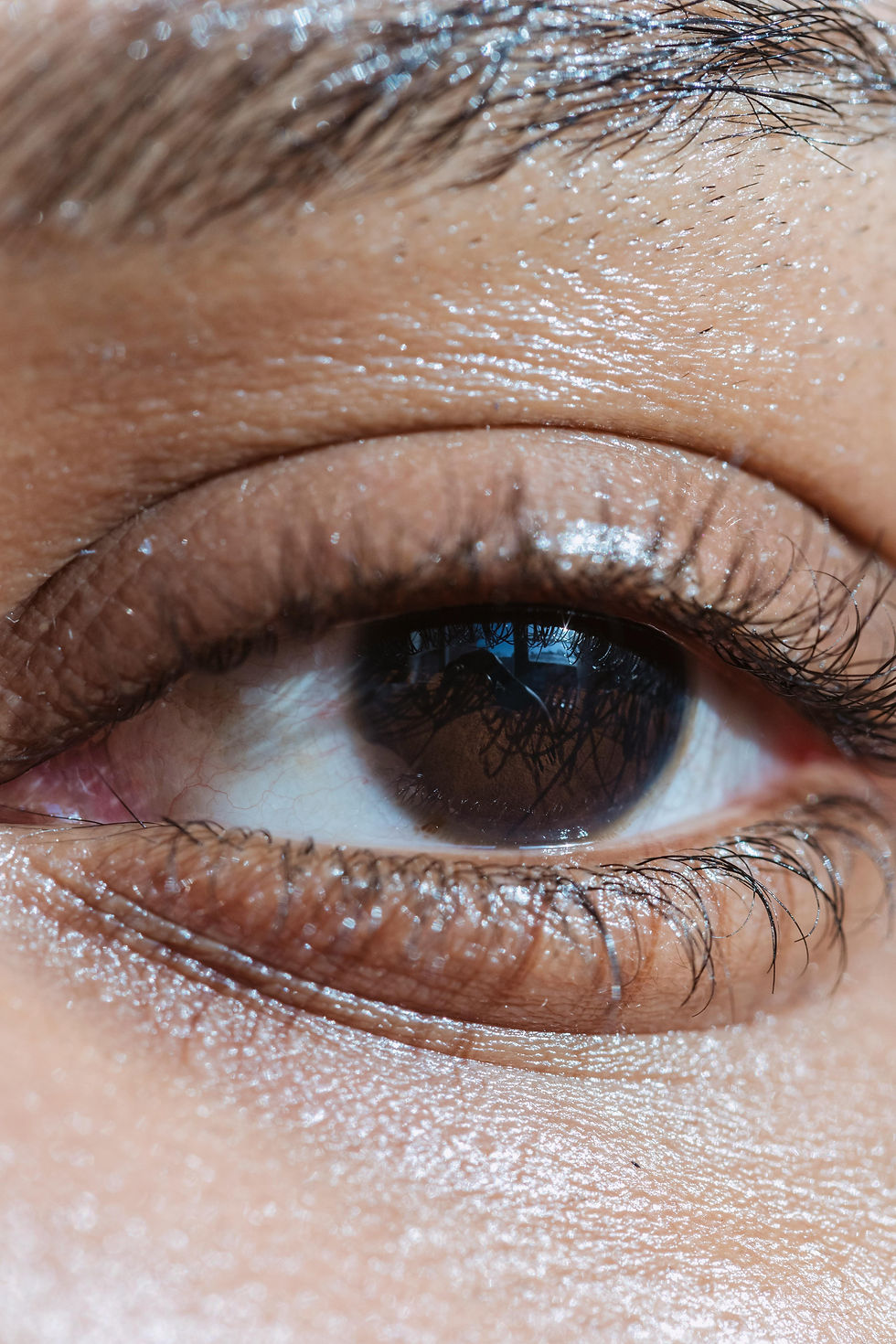 mild ptosis.jpg