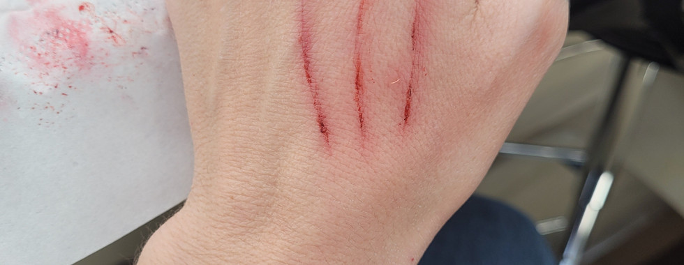 cat scratch