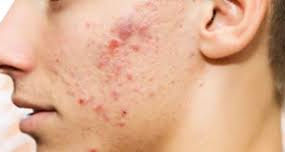 【文風筆動】粉刺的中醫治療