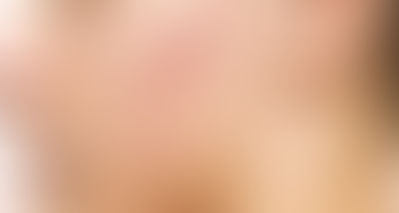 【文風筆動】粉刺的中醫治療