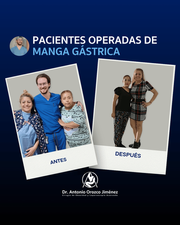 Antes y después de manga gástrica en León Guanajuato.