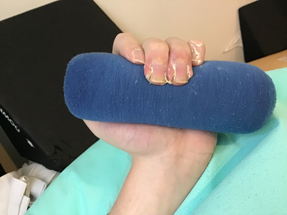before my first paronychia surgery