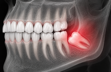 wisdom teeth 2.png