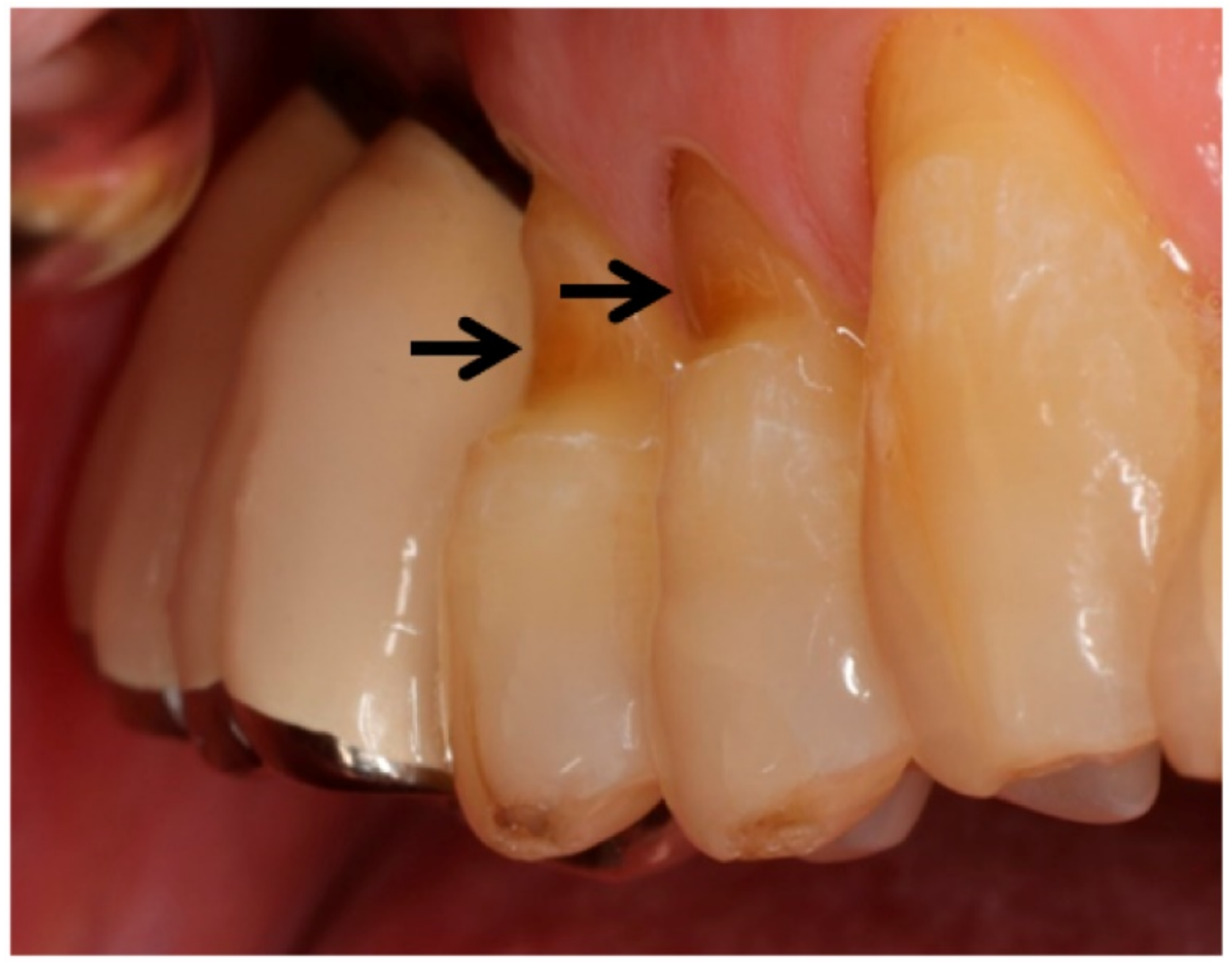 tooth abfraction