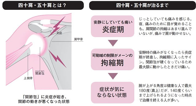四十肩・五十肩・肩の痛みの概要
