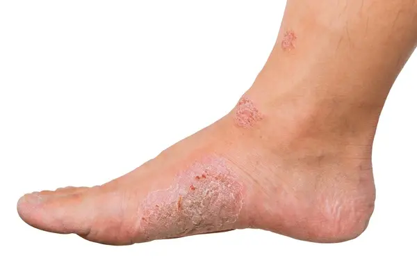 Close-up of a human foot showing dry, scaly skin patches, possibly a skin condition. White background, emphasizing texture and detail.