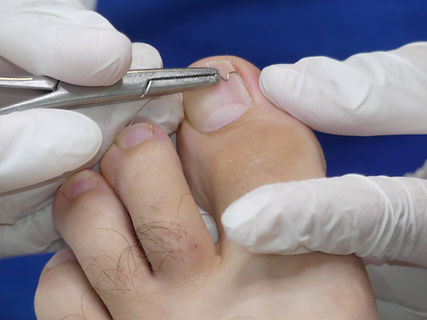 Ingrown Toenail