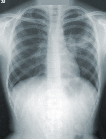 X-ray showing Pneumonia_edited.jpg