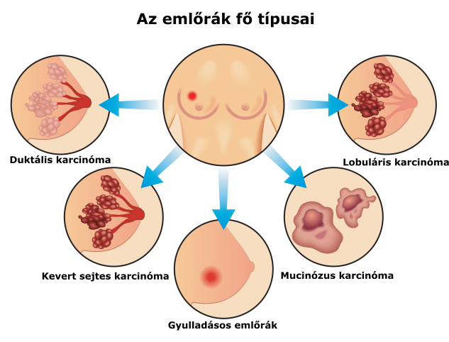 emlőrák tünetei)