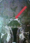 Tumor%202_edited.jpg