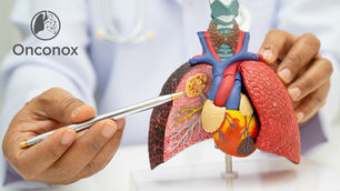 Why Localized Drug Delivery Represents the Next Frontier in Thoracic Oncology