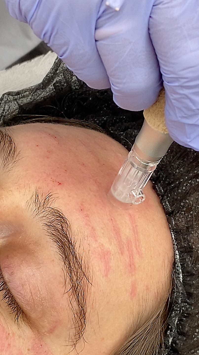 Microneedling piel sensible con arrugas
