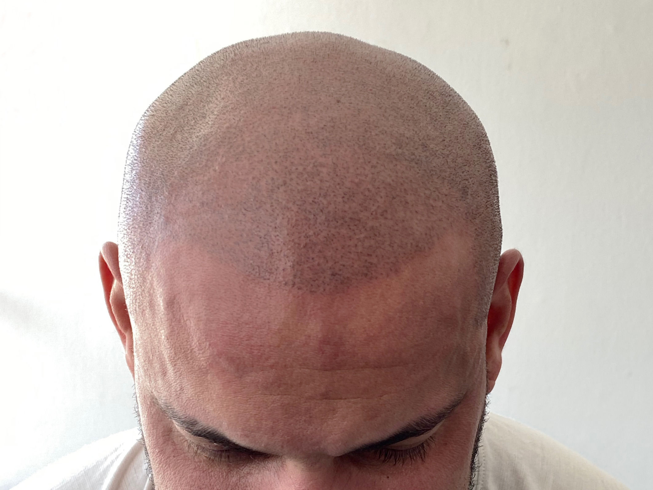 hombre con cabeza rapada y tricopigmentación