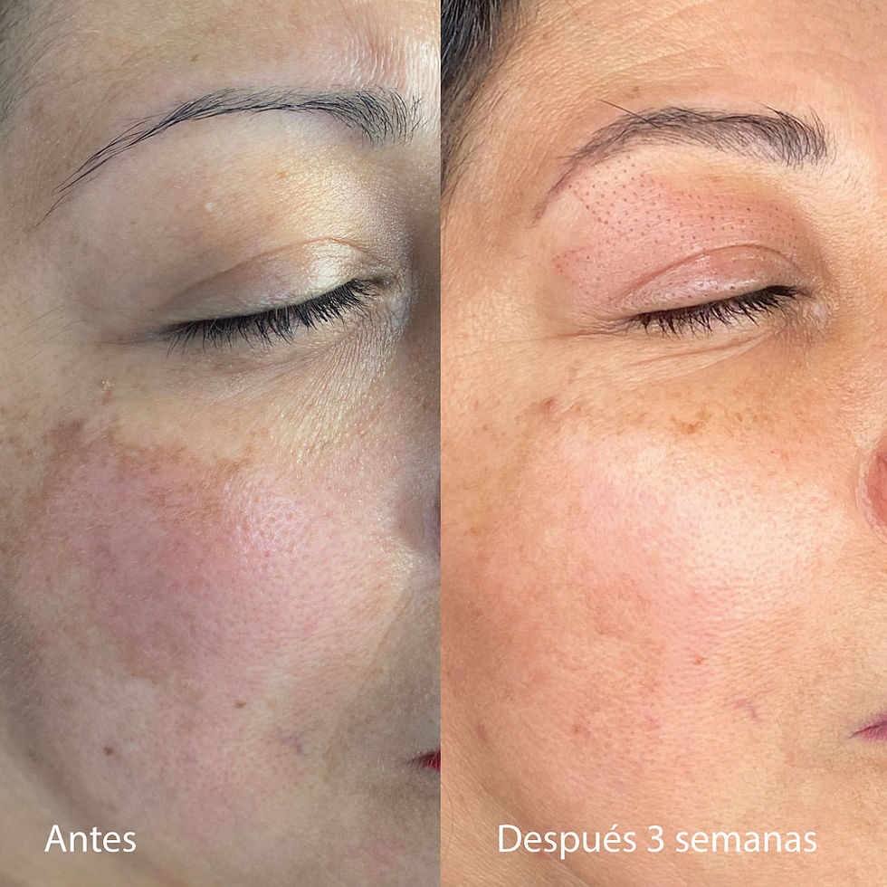Primer plano de mejilla y ojo cerrados: comparación Antes y Después 3 semanas, con menos manchas y enrojecimiento, tratamiento de microneedling.