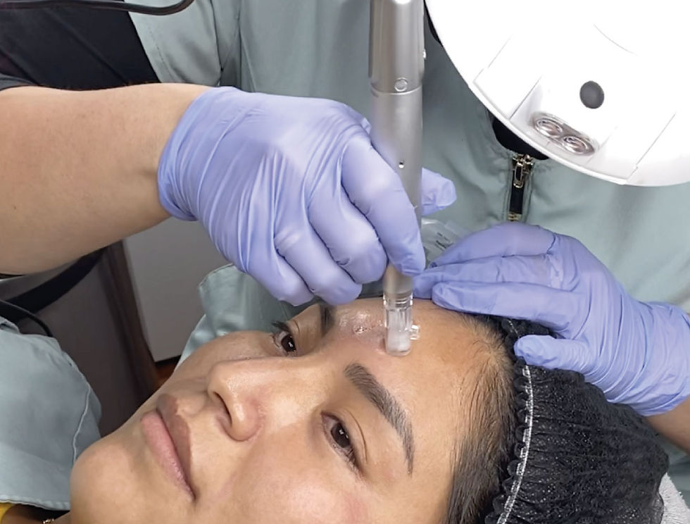 Terapia facial de microneedling: manos con guantes aplican un dispositivo en la frente de una mujer recostada.