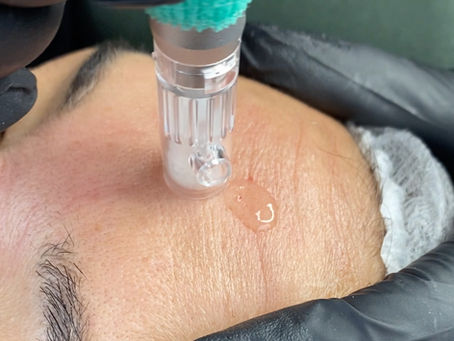 Tratamiento de microneedling con Phiion
