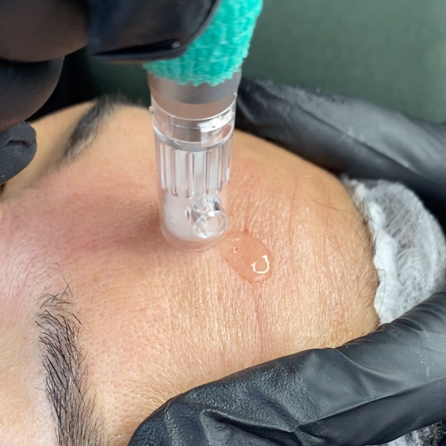 Primer plano de una frente con un dispositivo estético de microneedling aplicando gel, con manos enguantadas y banda blanca; ambiente de spa.