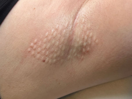 Botox tegen zweten