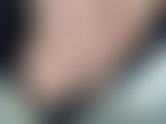 A psoríase ungueal, uma manifestação da psoríase que afeta as unhas, pode ter sintomas semelhantes à micose, o que torna o diagnóstico desafiador.