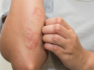 A dermatite atópica é uma condição que vai muito além de pele sensível. Afeta milhões de crianças e exige atenção constante para garantir que elas possam ter qualidade de vida.