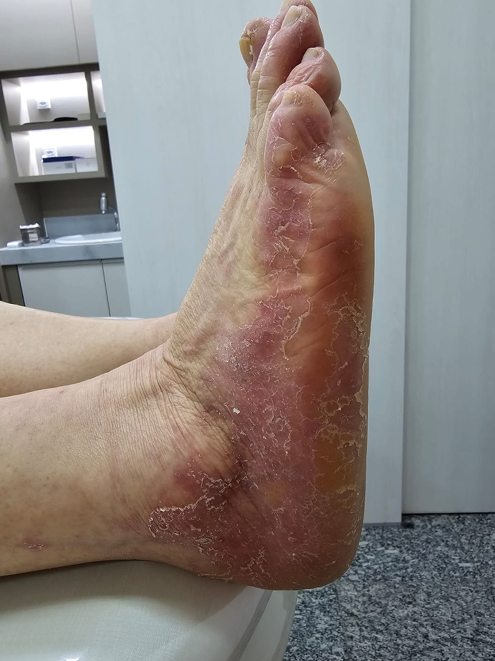 Os quimioterápicos modernos, apesar de altamente eficazes, podem desencadear uma série de efeitos colaterais, incluindo reações cutâneas