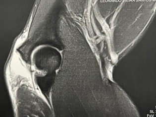A lesão do tríceps é uma condição relativamente rara, representando apenas 0,8% de todas as lesões de tendão.