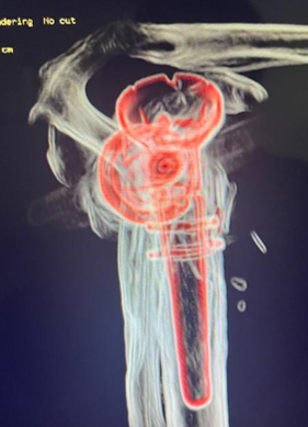 A prótese reversa tem se mostrado uma solução eficaz nesses casos, oferecendo melhor estabilidade e funcionalidade ao ombro.