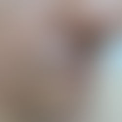 As pintas e outras lesões na pele são extremamente comuns, mas em alguns casos, elas podem representar um risco para a saúde, especialmente quando há suspeita de câncer de pele.