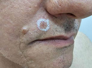 As pintas e outras lesões na pele são extremamente comuns, mas em alguns casos, elas podem representar um risco para a saúde, especialmente quando há suspeita de câncer de pele.