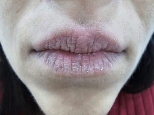 A queilite pode parecer um problema simples, mas suas causas são variadas e, em alguns casos, graves. O diagnóstico precoce é o caminho para o tratamento eficaz e para evitar complicações.