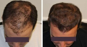 Can You Wear Short Hair After Male Hair Restoration?