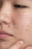 acne client