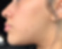 Virtual Teen Acne client-  after 