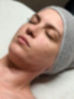 client with dry, acneic, congested skin - before