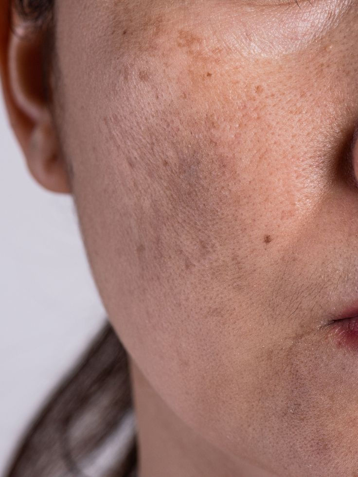 Melasma and Sunspots