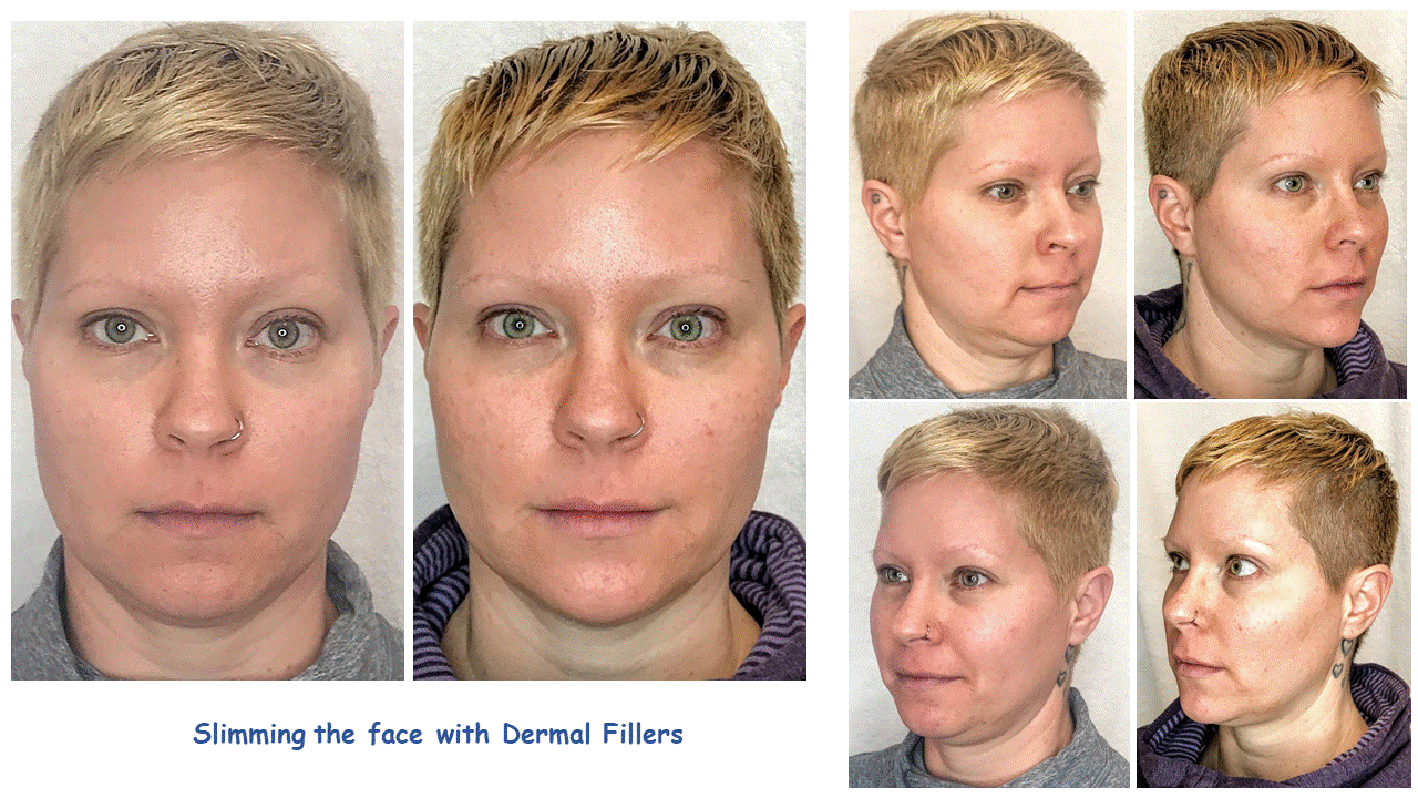 full face fillers 6.gif