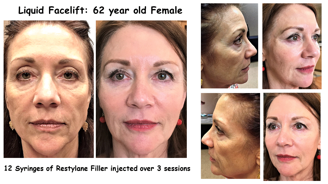 full face fillers 4.gif