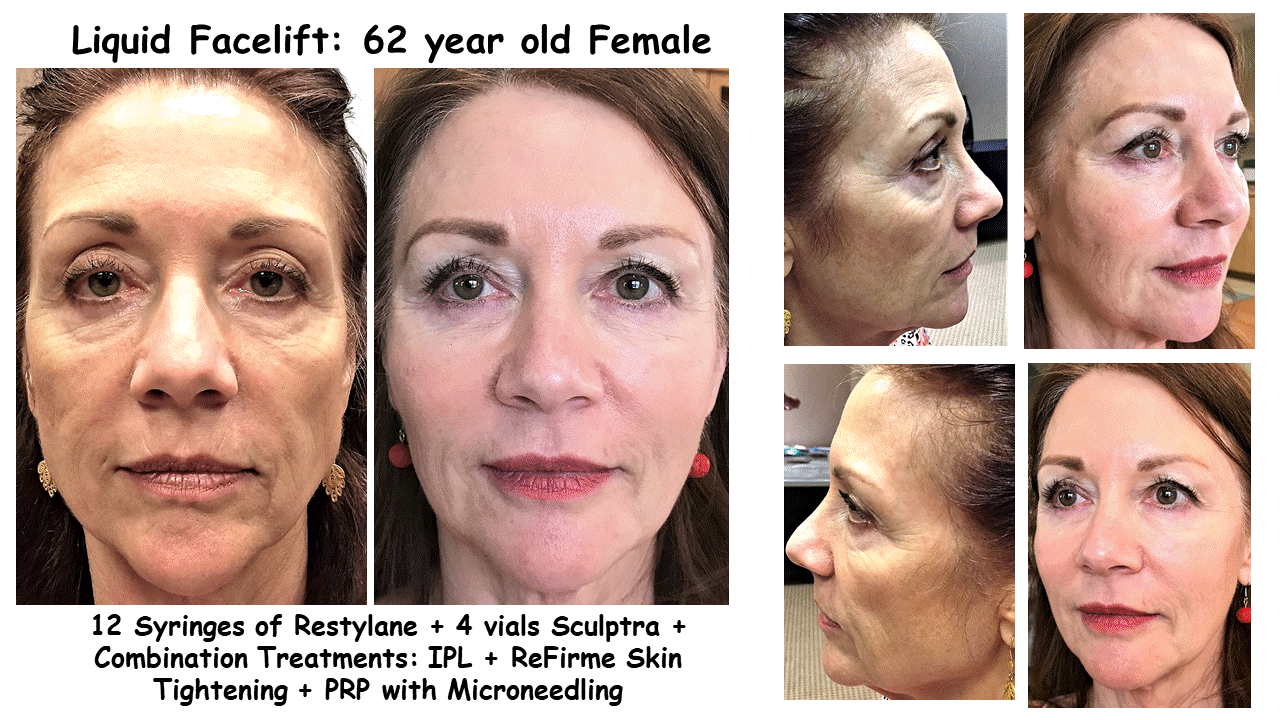 Frances Liquid Facelift.gif