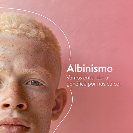 Albinismo: vamos entender a genética por trás da cor