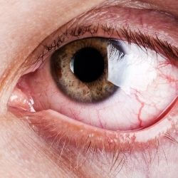 dry-eyes