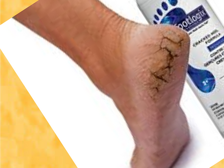 Callus Managing (Medical) Pedicure