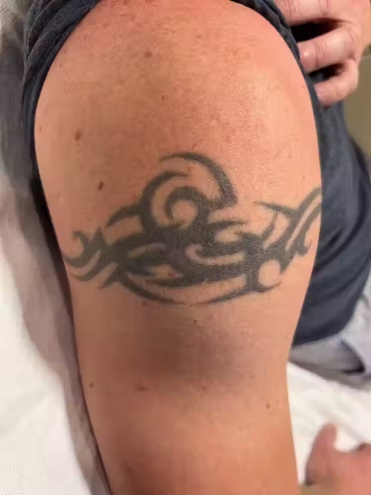 Tattoo_Removal_Before_at_The_Spa_by_Sheena.avif
